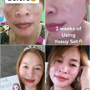 Yasuy Stunning White Beauty Set Removes Pimples
